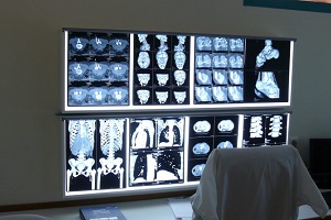 MRI knie